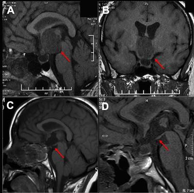 Extended endoscopic endonasal approach for resecting anterior intrinsic third ventricular craniopharyngioma